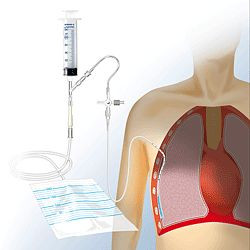 SÖHNGEN Pleura-und Thoraxdrainage-Set, Komplett-Set nach Matthys, 0106155